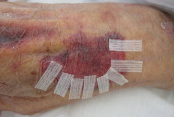  入院時テア発生