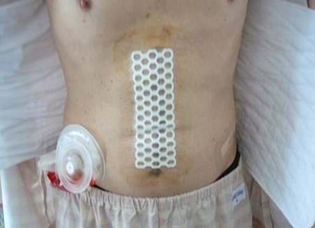  「まもりたい」でストーマ装具とガーゼ固定