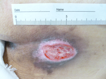 3 、発生から6週間後