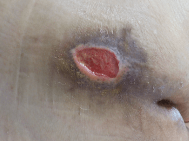 4 発生から7週間後（転院直前） DESIGN-R：D3-e3s3i0g0n0p0=6点