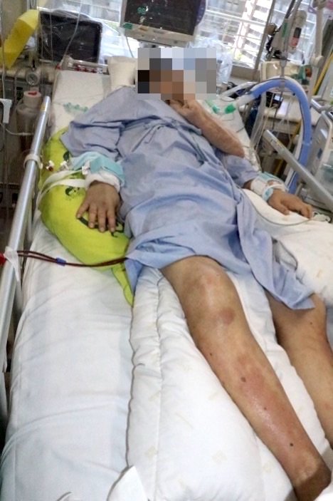 ICU：リスク軽減のために、分割して複数組み合わせて使用①